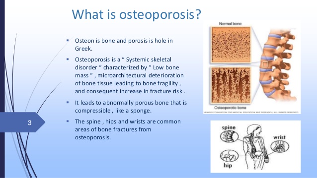 osteoporosis because of testosterone